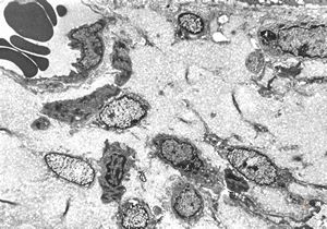 jejunum … lipid malabsorption jejunum … lipid malabsorption